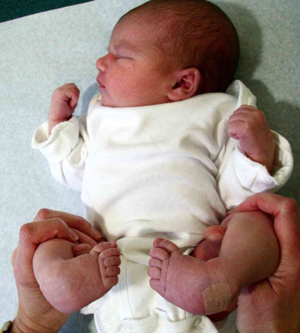 Club Foot
